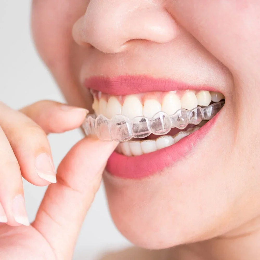 Teeth Whitening Mouth Guard - 1-4 ชิ้น อุปกรณ์ป้องกันการกรนและบดฟันขณะนอนหลับ แผ่นป้องกันฟันสำหรับการนอนหลับ อุปกรณ์ช่วยลดการบดฟัน แผ่นป้องกันเหงือก