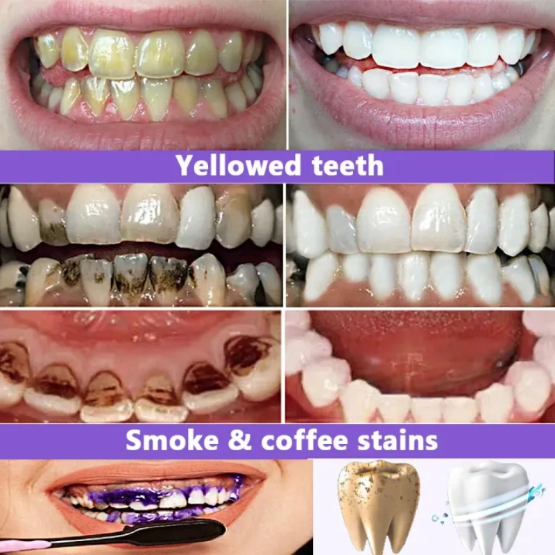 ยาสีฟันไวท์เทนนิ่งขายดีที่สุดป - Teeth Whitening Effective บทวิจารณ์และราคา