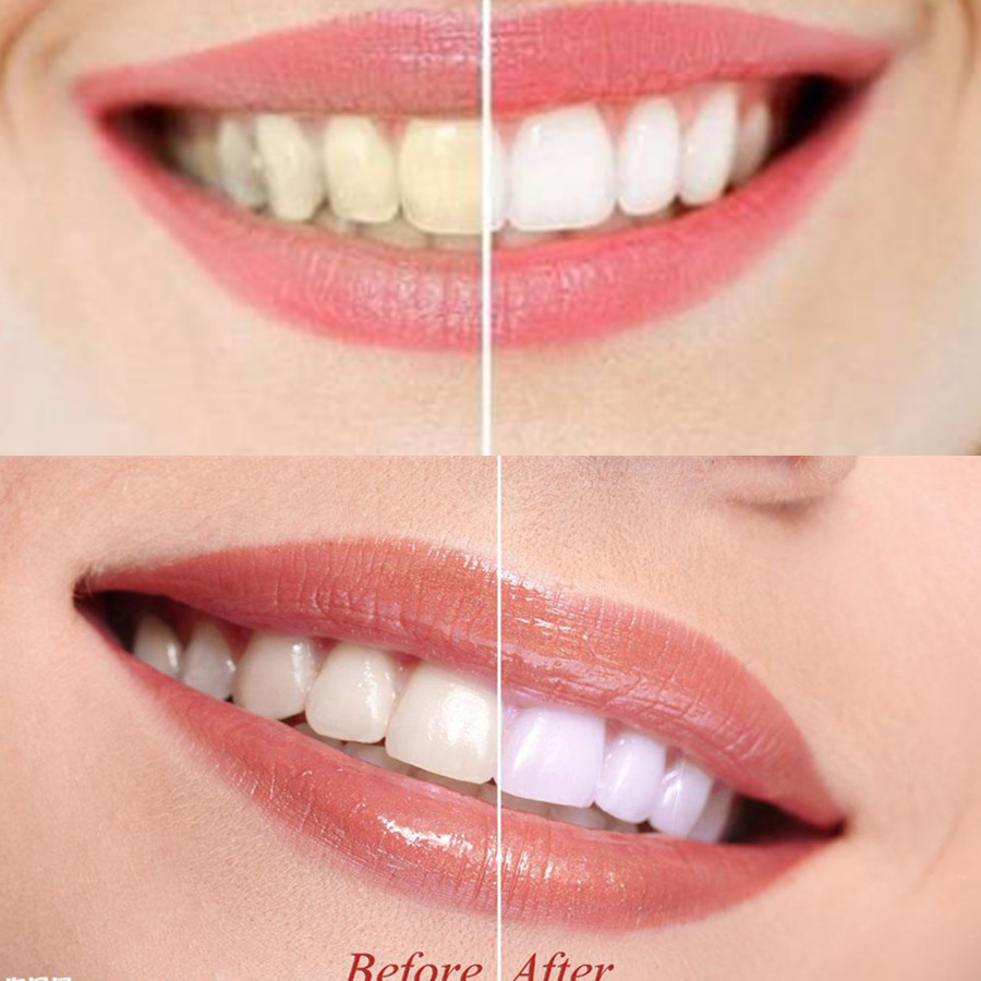 ถ่านไม้ไผ่ฟันฟันทันตกรรมสูตร L - Teeth Whitening Hismile บทวิจารณ์และราคา
