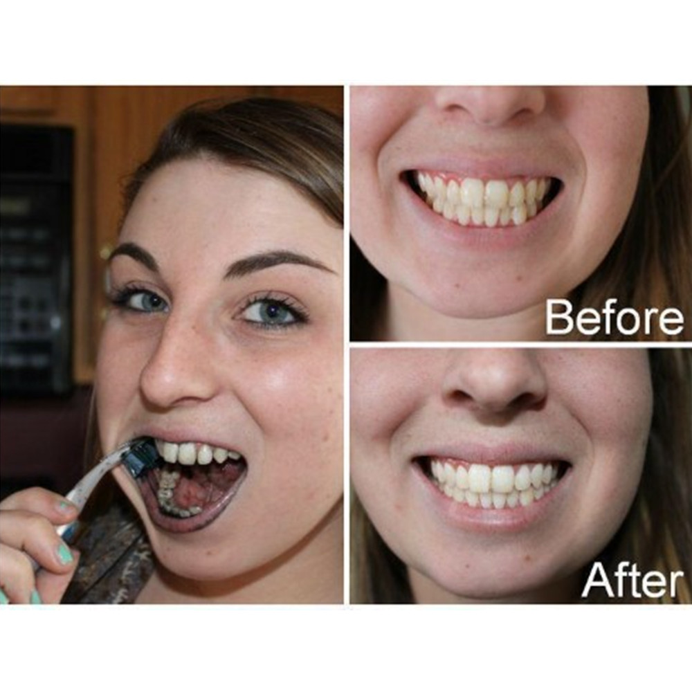 ถ่านไม้ไผ่ฟันฟันทันตกรรมสูตร L - Teeth Whitening Hismile บทวิจารณ์และราคา