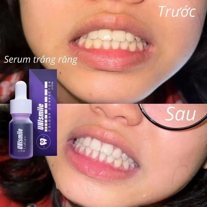 ยูนิสไมล์ เอสเซนส์ฟอกฟันขาว 10 - Teeth Whitening Effective บทวิจารณ์และราคา