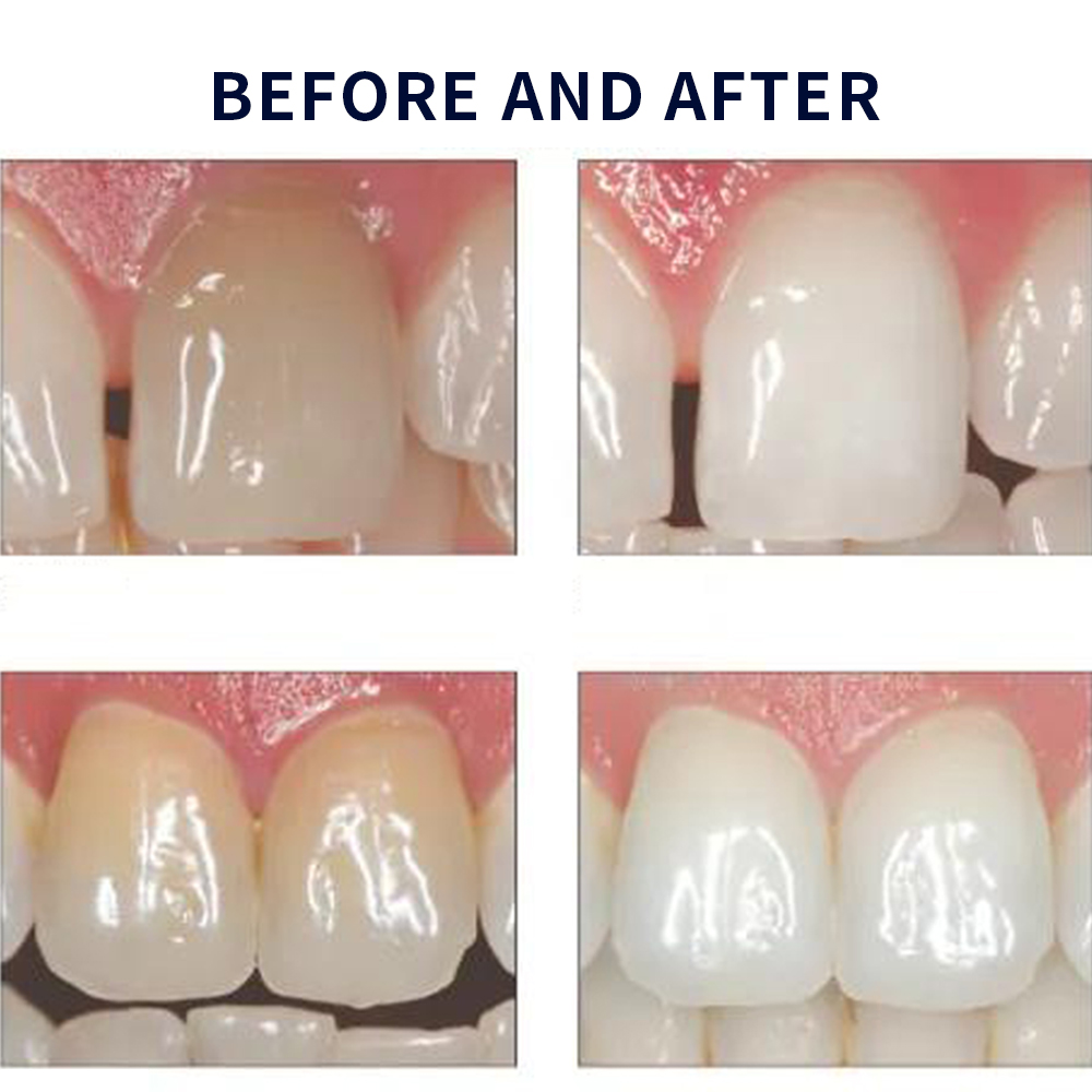 20% pF 20 16ชุดเจล8x1.2มล. ชุด - Teeth Whitening Hismile บทวิจารณ์และราคา