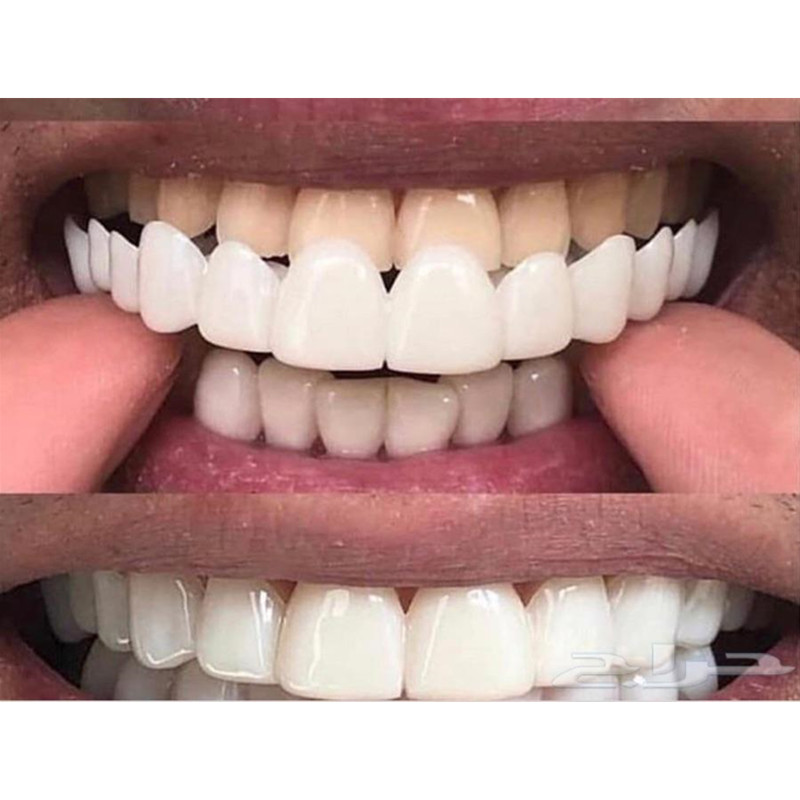 ซิลิโคนเจลทันตกรรม Upper ปลอมฟ - Teeth Whitening Moulds บทวิจารณ์และราคา