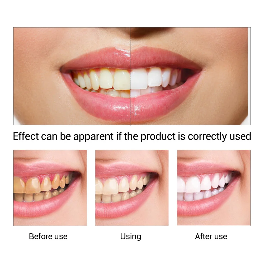 FTEENPLY ฟันไวท์เทนนิ่ง Oral ส - Teeth Whitening Hismile บทวิจารณ์และราคา