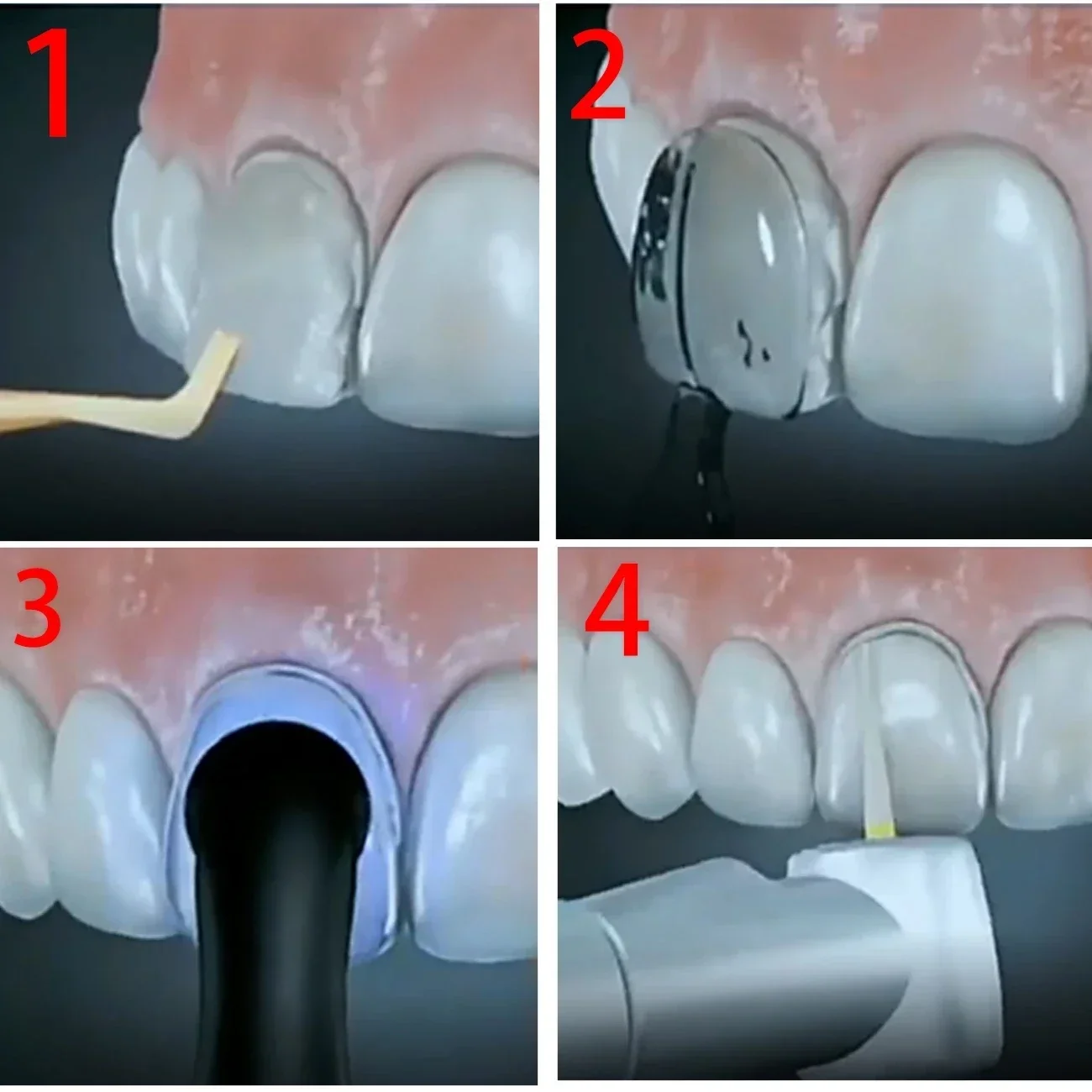 ชุดอุปกรณ์ทำแม่พิมพ์สำหรับงานท - Teeth Whitening Moulds บทวิจารณ์และราคา