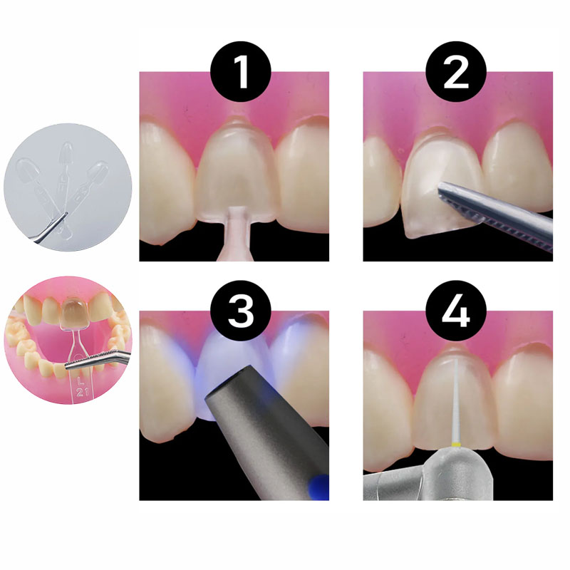 ชุดแม่พิมพ์เรซิ่นคอมโพสิตแบบอบ - Teeth Whitening Moulds บทวิจารณ์และราคา
