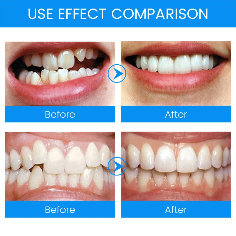 3 ขั้นตอนทันตกรรมจัดฟันฟัน Ret - Teeth Whitening Mouth Guard บทวิจารณ์และราคา