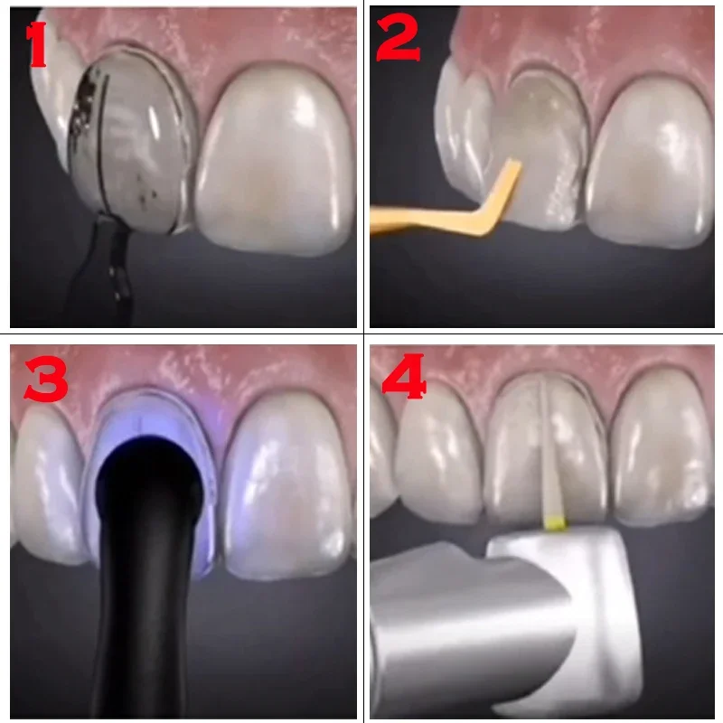 แม่พิมพ์ฟันสำหรับวีเนียร์เรซิน - Teeth Whitening Moulds บทวิจารณ์และราคา