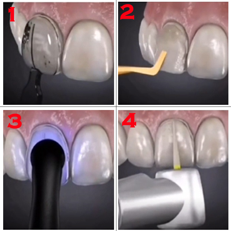 ชุดแม่พิมพ์วีเนียร์ฟัน 32 ชิ้น - Teeth Whitening Moulds บทวิจารณ์และราคา