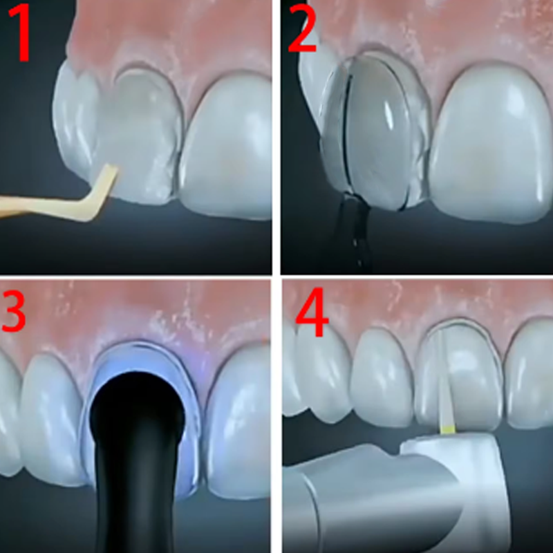 ชุดแม่พิมพ์แผ่นไม้อัดทำฟัน32ชิ - Teeth Whitening Moulds บทวิจารณ์และราคา